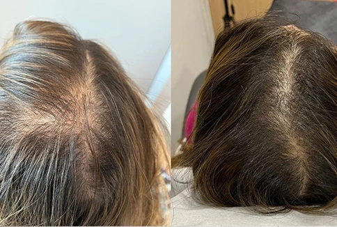 01 mesoterapia