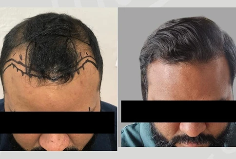 01 trasplante capilar