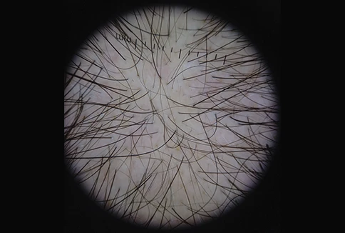 01 tricoscopia