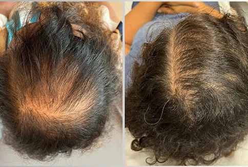 02 mesoterapia