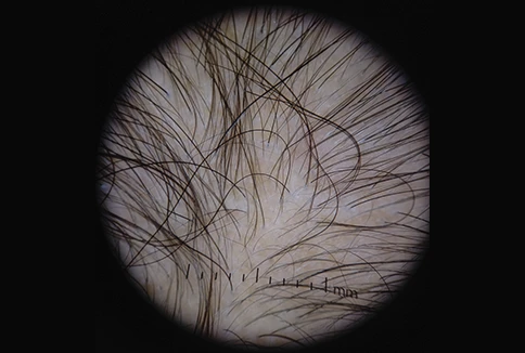 02 tricoscopia