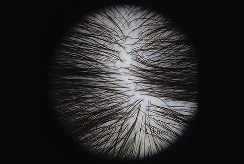 03 tricoscopia