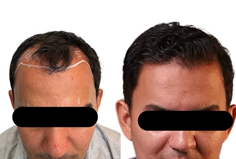 resultado-transplante-capilar-emice-hair-1.1.webp