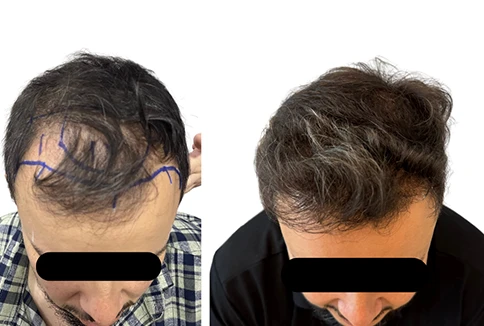 resultado-transplante-capilar-emice-hair-1.10.webp