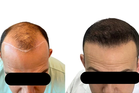 resultado-transplante-capilar-emice-hair-1.2.webp