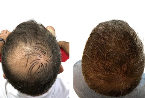 resultado-transplante-capilar-emice-hair-1.3.webp