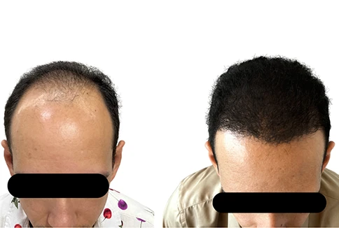 resultado-transplante-capilar-emice-hair-1.4.webp