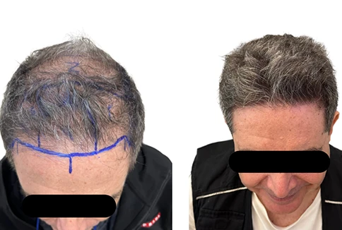 resultado-transplante-capilar-emice-hair-1.5.webp