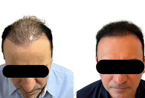 resultado-transplante-capilar-emice-hair-1.6.webp