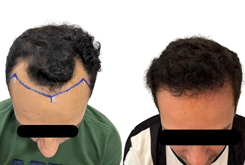 resultado-transplante-capilar-emice-hair-1.7.webp