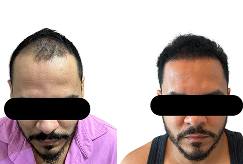 resultado-transplante-capilar-emice-hair-1.8.webp