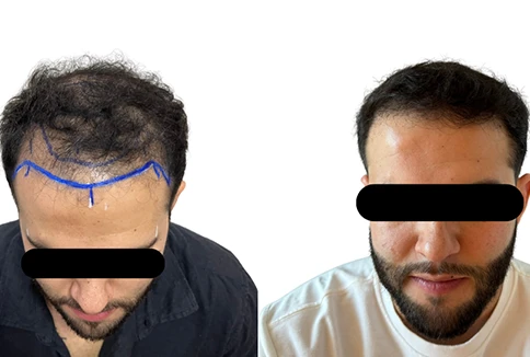 resultado-transplante-capilar-emice-hair-1.9.webp